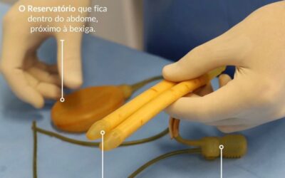 Entenda como funciona a prótese peniana Inflável